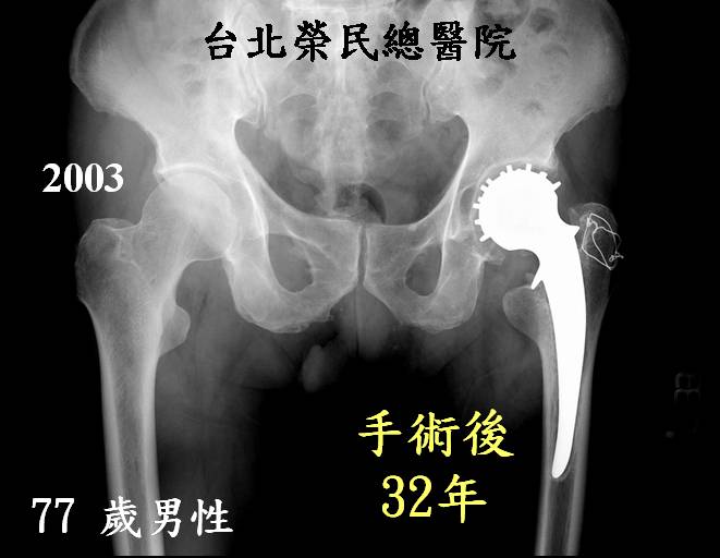 改良式小傷口人工髖關節手術之介紹暨人工髖關節之回顧與展望