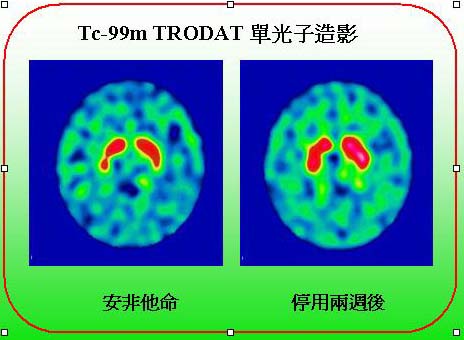 Tc-99m TRODAT lyv ϬlwDLR kϬΨg